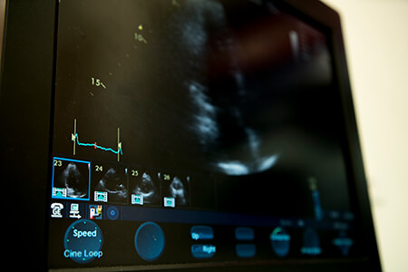 Echocardiogram (echo)